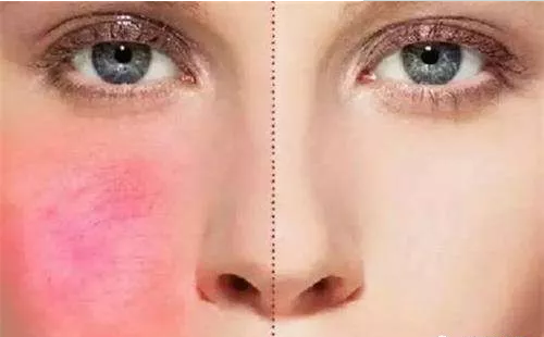 激素臉紅血絲癥狀為什么那么難修復