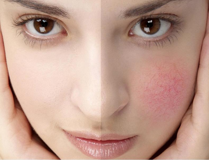 敏感肌換季如何護理？