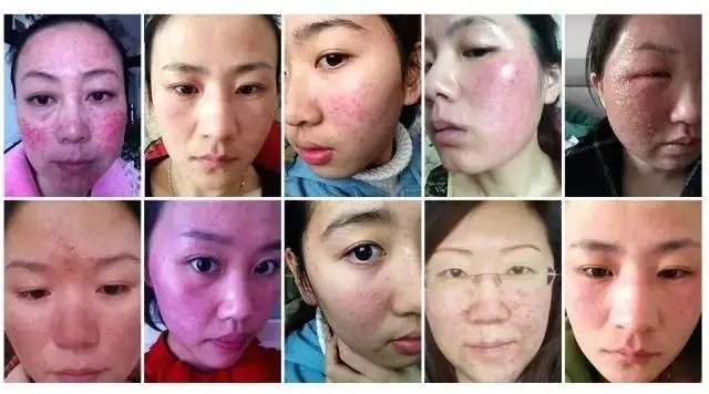 如何判斷自己的皮膚是不是激素臉？