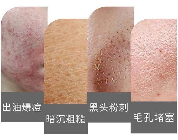 如何預防毛孔堵塞？預防毛孔堵塞的方法