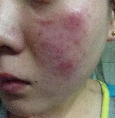 紅血絲的種類有哪些？