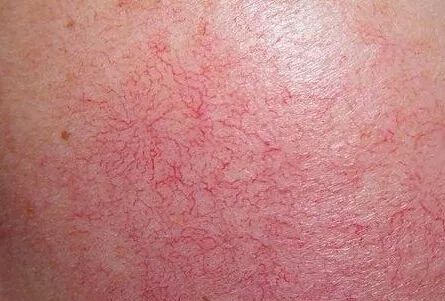 紅血絲的種類有哪些？