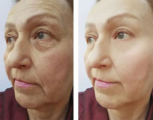 臉部松弛下垂如何改善？面部松弛下垂改善方法！