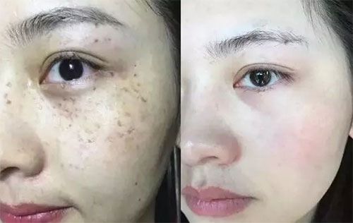 祛斑方法哪種效果最好？