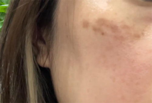 祛斑反黑色素沉著怎么消除？