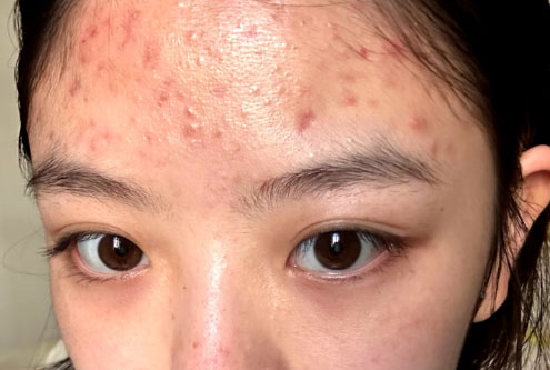 油痘肌怎么改善？油痘肌的改善方法有哪些？